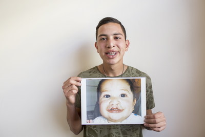 世界牙科联盟和微笑列车基金会携手启动唇腭裂儿童口腔健康改善项目