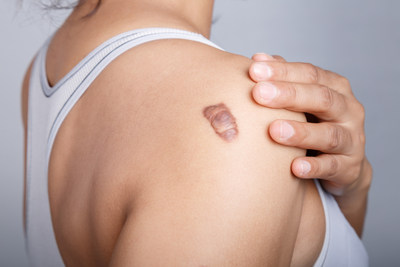 Soliton to initiate a proof of concept clinical trial for the use of its Rapid Acoustic Pulse (RAP) technology for the treatment of keloid and hypertrophic scars. (© weerajata - stock.adobe.com)
