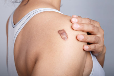 Soliton to initiate a proof of concept clinical trial for the use of its Rapid Acoustic Pulse (RAP) technology for the treatment of keloid and hypertrophic scars. (© weerajata - stock.adobe.com) Soliton to initiate a proof of concept clinical trial for the use of its Rapid Acoustic Pulse (RAP) technology for the treatment of keloid and hypertrophic scars. (© weerajata - stock.adobe.com)