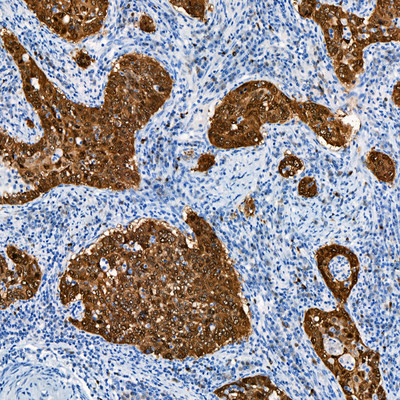 Cervical Squamous Cell Carcinoma (SqCC) Stained with p16 INK4a [BC42]