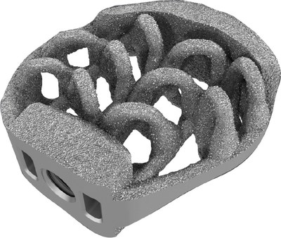 SPIRA&reg;-O Open Matrix OLIF and its open matrix design contain multiple pathways throughout the implant for osseintegration. The arched design distributes load evenly across endplates with optimized surface contact. Each implant offers up to 40 points of endplate contact.