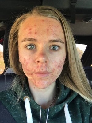 Before treatment