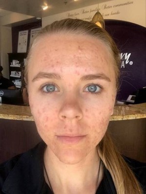 Results after the fourth treatment with the Acne Facial Series powered by Proactiv