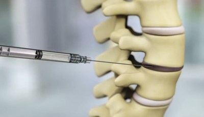 During treatment, a single dose of IDCT is injected into the painful disc percutaneously. During treatment, a single dose of IDCT is injected into the painful disc percutaneously.