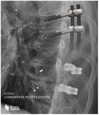 X-ray image of a stabilized section of the thoracic spine. The radiolucency of BlackArmor® material uncovers a clear view on the anatomical structures. Only markers remain visible to allow for verification of correct implant position. In the two cranial levels of the instrumented spine the implant contours are visualized for illustrative purposes. X-ray image of a stabilized section of the thoracic spine. The radiolucency of BlackArmor® material uncovers a clear view on the anatomical structures. Only markers remain visible to allow for verification of correct implant position. In the two cranial levels of the instrumented spine the implant contours are visualized for illustrative purposes.