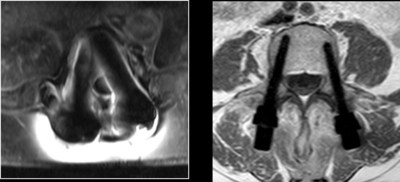 MRI pictures of Titanium pedicle screws (Left) and CarboClear pedicle screws (Right)